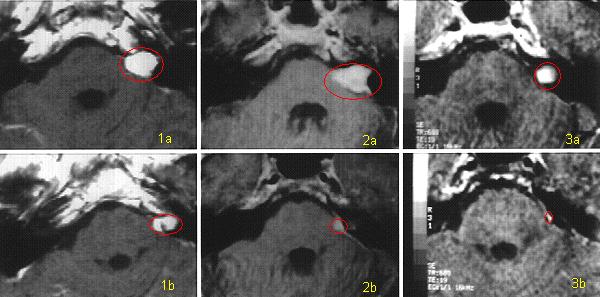 {Brain Tumor Treatment Results Acoustic Neuroma with Radiosurgery}