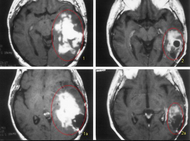 {Brain Tumor Treatment Results Glioblastoma with Radiosurgery}