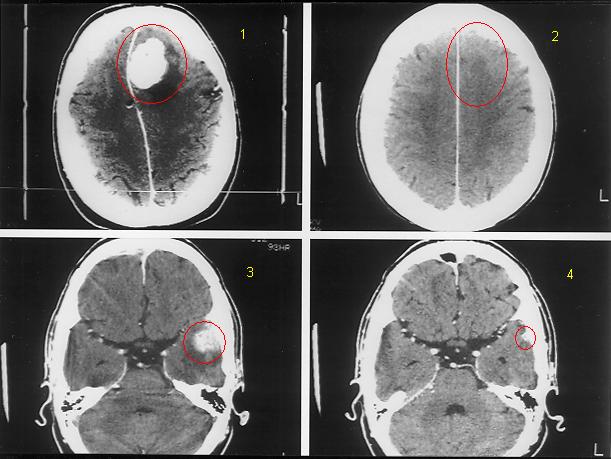 {Brain Metastasis before and after Gamma Radiosurgery presented by stereotactic.com}