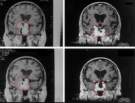 {Brain Tumor Treatment Results Pituitary Tumor with Radiosurgery}